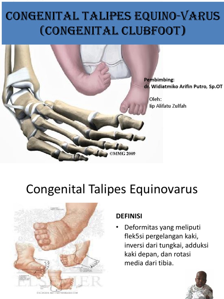 Congenital Talipes EquinoVarus PDF