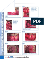 ACE Tissue Graft