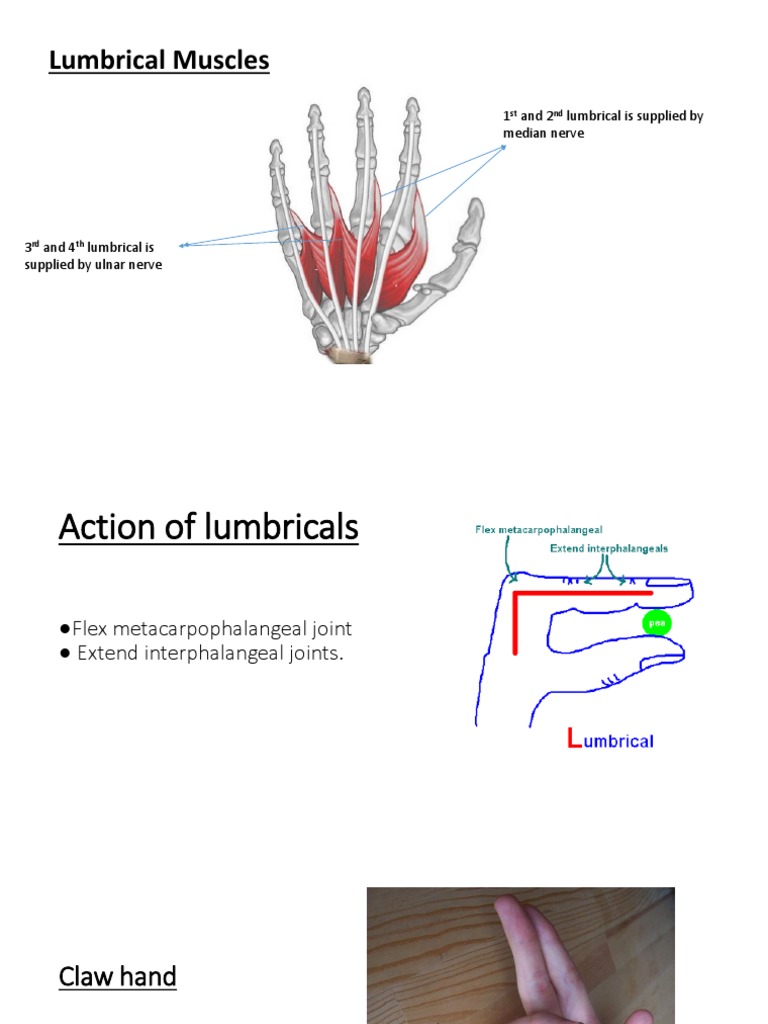 Claw Hand (Damage To Ulnar Nerve) PDF