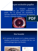 Glaucoma Por Seclusión Pupilar