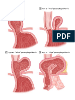 hernia 2 .pdf