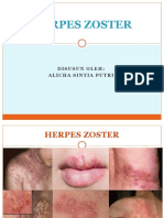 Herpes Zoster