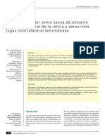 Mixoma Auricular Causa Oclusión de Arteria Central de Retina y Amaurosis Fugax Contralateral