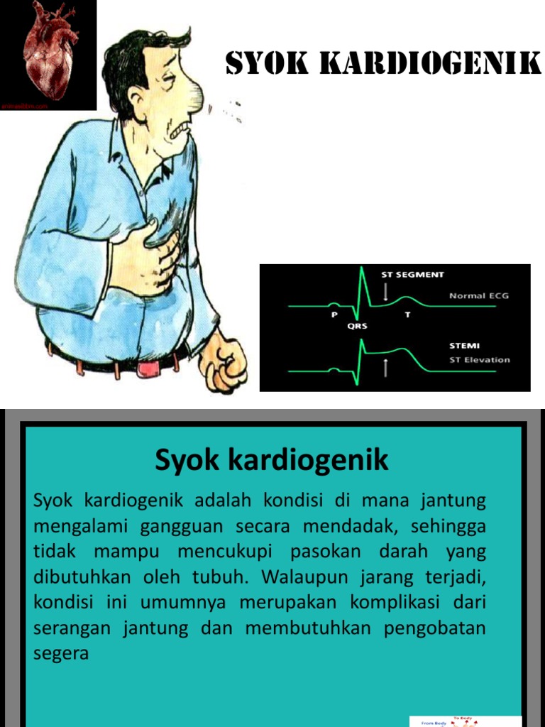 Syok Kardiogenik | PDF
