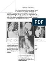 Gastric Volvulus