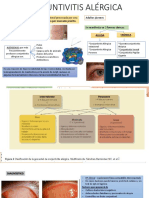 Conjuntivitis Alérgica