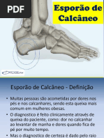 Esporão de Calcanho - Trabalho Podologia.pptx