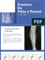 Fractura de Tibia y Peroné