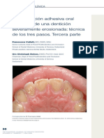 Rehabilitacion dental en casos de bruxismo o erosion 