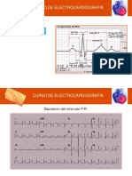 Qrs Ekg