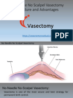 No Needle No Scalpel Vasectomy