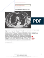 Crepitus and Subcutaneous Emphysema