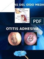 Patologías del oído medio: Otitis adhesiva, crónica y colesteatomatosa