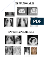 QUISTES PULMONARES