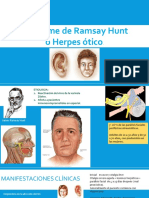 Síndrome de RAMSAY HUNT.pptx