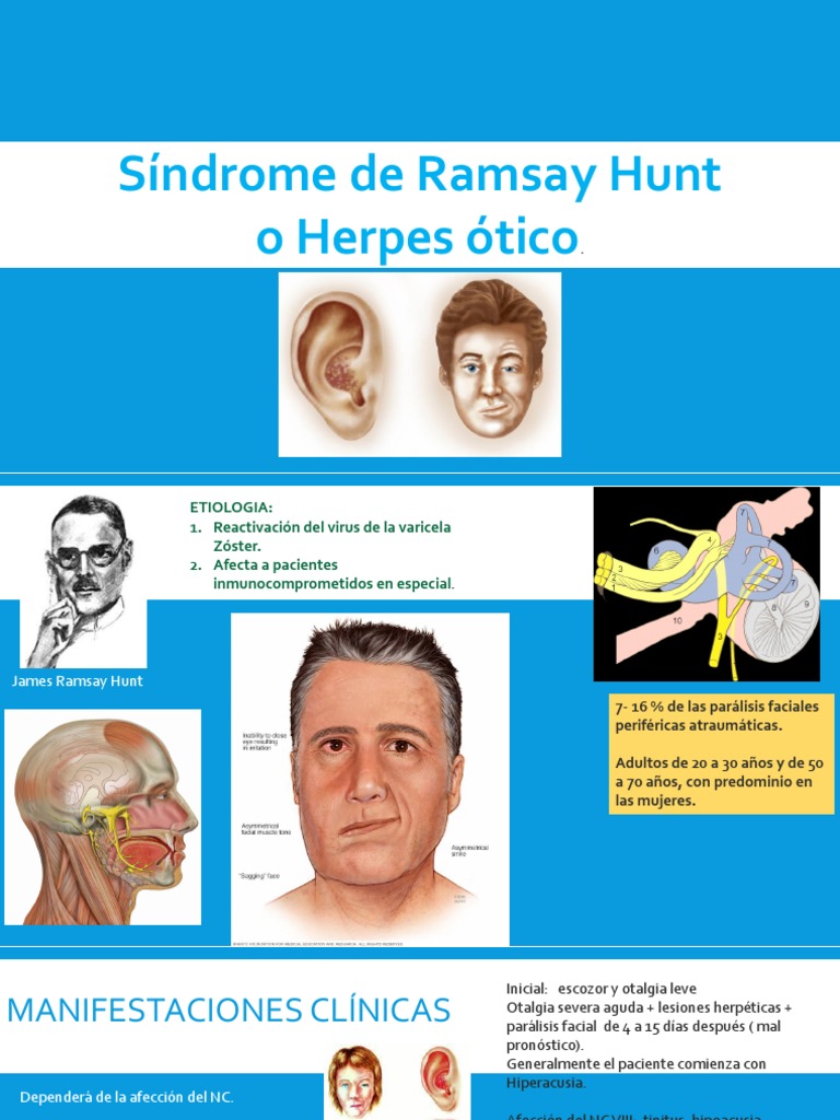 Síndrome de Ramsay Hunt: Diagnóstico y Tratamiento | PDF