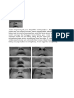Analisis Fotogrametri Pada Pasien Dengan Bibir Sumbing Lengkap