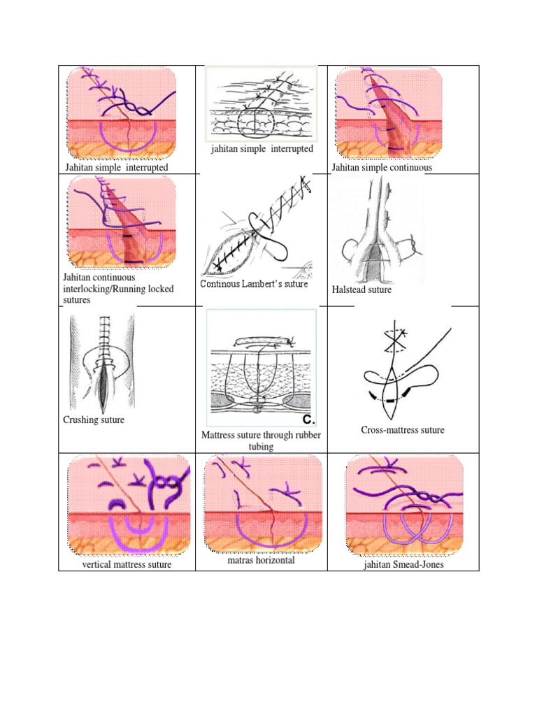 Macam Macam Jahitan Luka | PDF