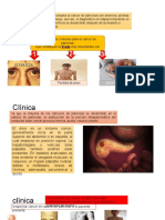 Cáncer de Pancreas