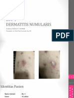 BST4 Dermatitis Numularis Muncizzz