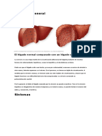 Cirrosis Hepatica