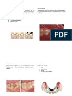 Caries Dental y Grados de Caries