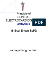 EKG Aritmia