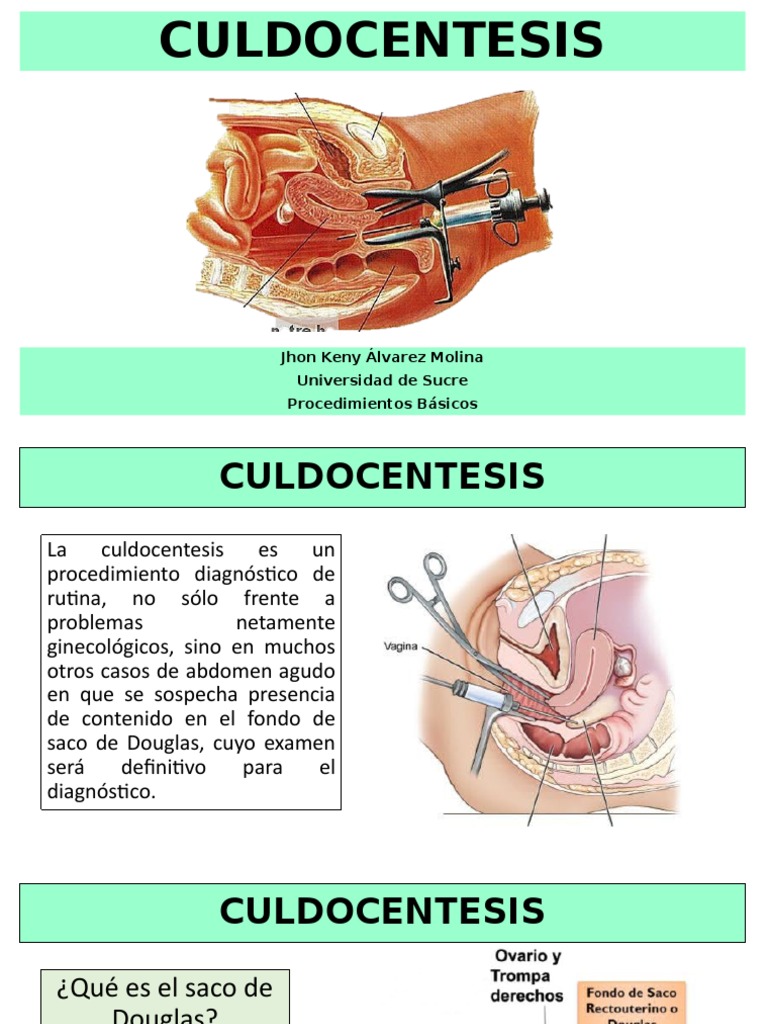 Culdocentesis | PDF | Útero | Peritoneo
