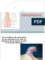 HIPOSPADIAS