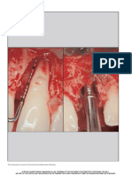 Save the natural tooth or place an implant ? A Periodontal decisional criteria to perform a correct therapy. Ricci, Ricci & Ricci. The International Journal of Periodontics & Restorative Dentistry, 2011; 31, 29-37. .pdf