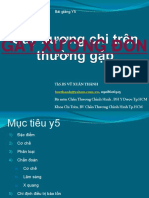 Gãy Xương Đòn