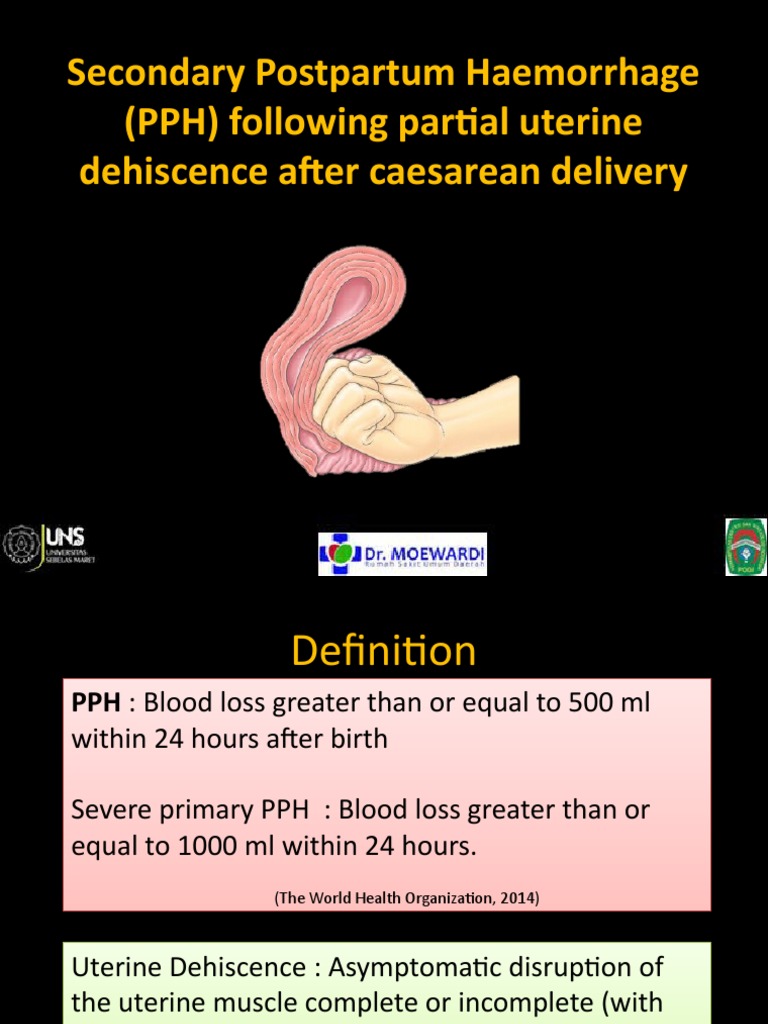 Secondary Postpartum Haemorrhage (PPH) Following Partial | PDF ...