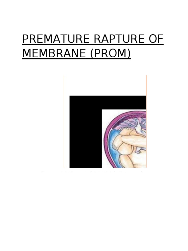 understanding-premature-rupture-of-membranes-pdf-preterm-birth