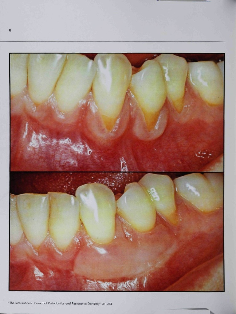 Holbrook T, Ochsenbein C. Complete Coverage of The Denuded Root Surface ...