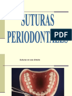 Suturas en Periodoncia