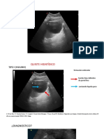 Tipos de Hidatidosis