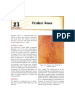  Pityriasis Rosea
