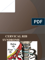 Cervical Rib