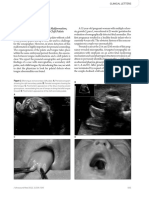 Bifid Tongue, A Rare Congenital Malformation, Is A Prenatal Clue For Secondary Cleft Palate