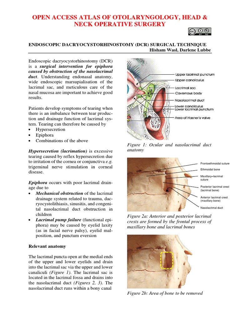 Endoscopic Dacryocystorhinostomy DCR Surgical Technique PDF