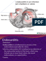 Endocarditis