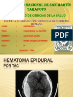 Hematoma Epidural y Subdural