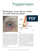 Hordeolum: Acute Abscess Within An Eyelid Sebaceous Gland: The Clinical Picture
