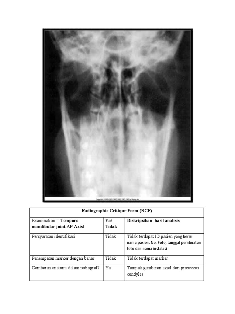 Evaluasi Radiografi TMJ AP Axial | PDF
