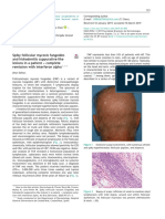 Spiky Follicular Mycosis Fungoides and Hidradenitis Suppurativa-Like Lesions in A Patient - Complete Remission With Interferon Alpha