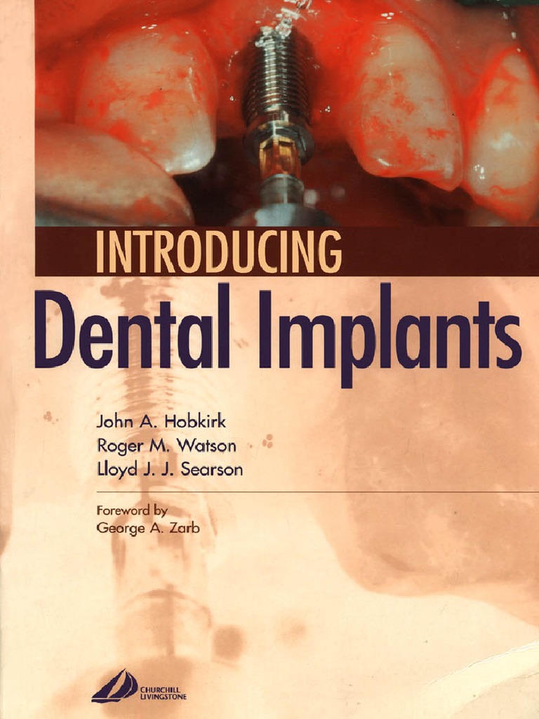 Introducing Dental Implants PDF | PDF | Dental Implant | Human Tooth
