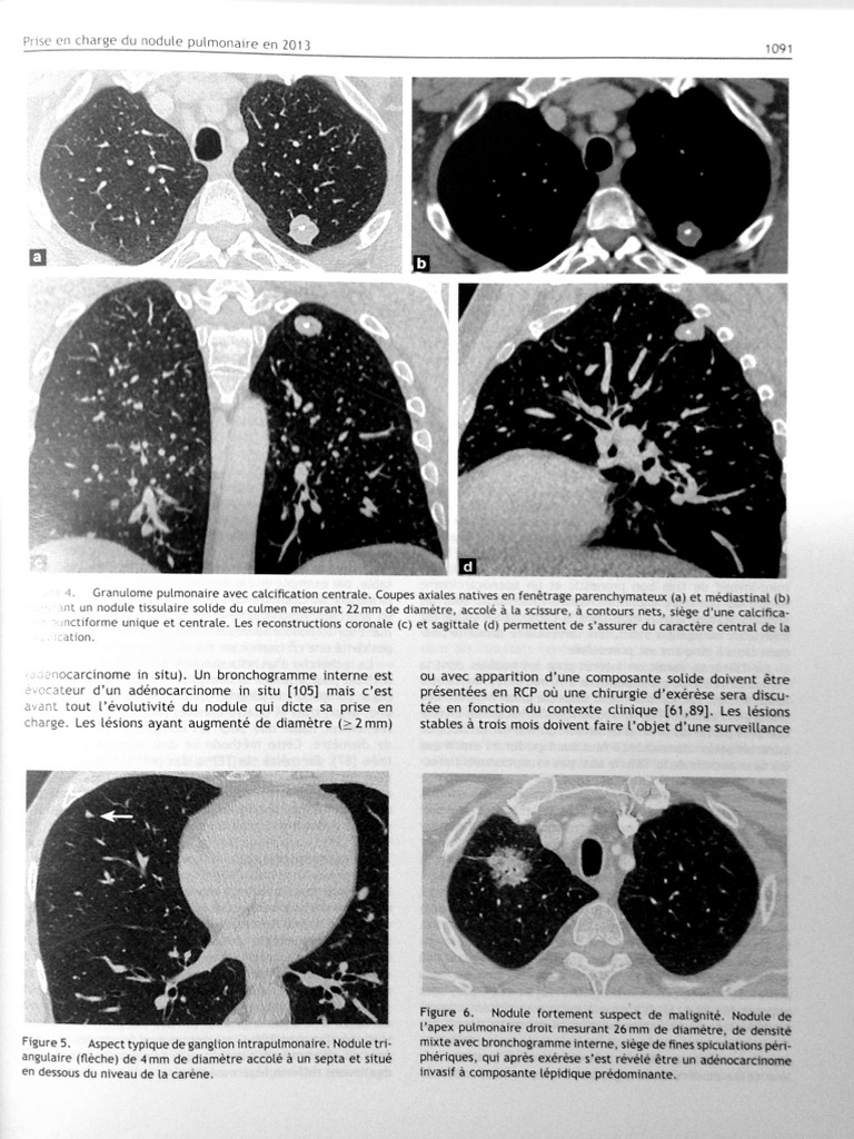 Nodule Pulmonaire Définition Nodule Pulmonaire Dangereux OJTI — free download