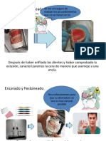 Técnicas de encerado y acrilizado para prótesis dentales