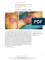 Pyoderma Gangrenosum in Ulcerative Colitis