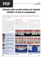 finalização estética em dentes anteriores pós tratamento ortodôntico
